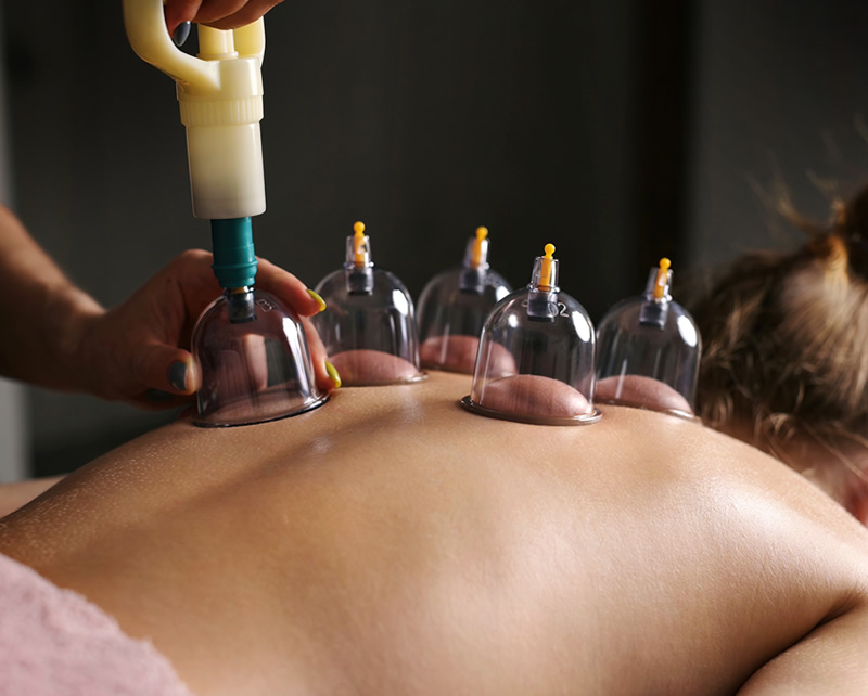 Cupping therapy treatment for muscle pain and recovery at startPTNow
