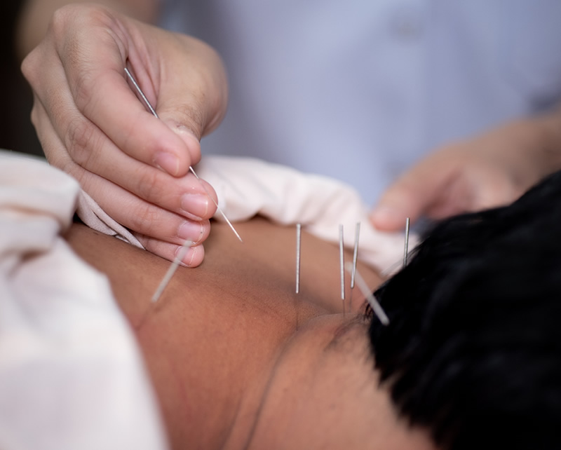 Dry needling treatment for muscle pain at startPTNow